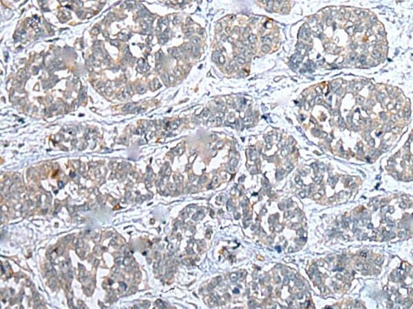Immunohistochemical analysis of paraffin-embedded Human oesophagus cancer tissue using #43383 at dilution 1/25.