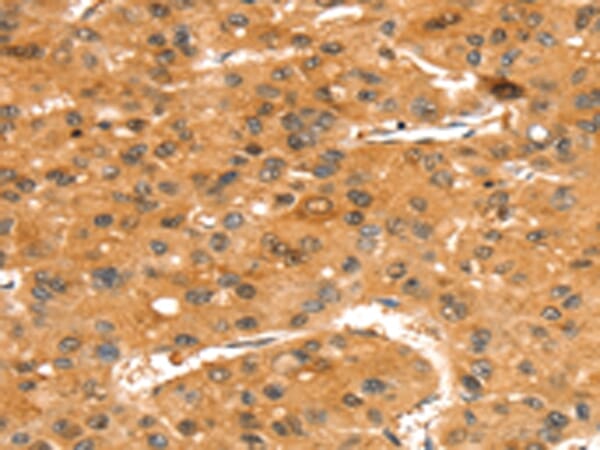 Immunohistochemical analysis of paraffin-embedded Human liver cancer tissue using #43417 at dilution 1/35,