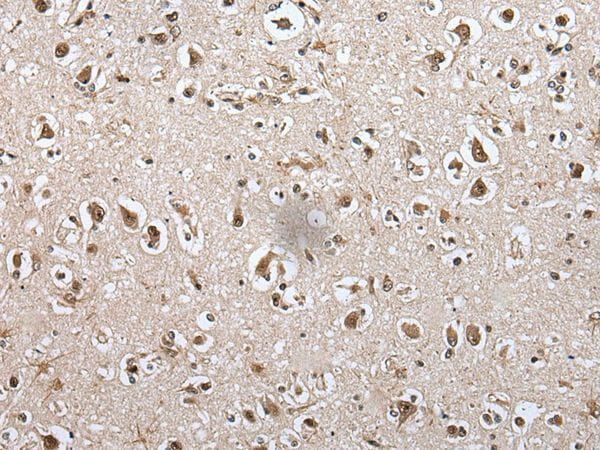 The image on the left is immunohistochemistry of paraffin-embedded Human brain tissue using METAP1D Antibody at dilution 1/100, on the right is treated with fusion protein. (Original magnification: x200)