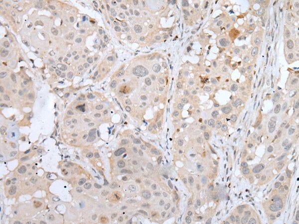The image on the left is immunohistochemistry of paraffin-embedded Human oesophagus cancer tissue using BORCS8 Antibody at dilution 1/100, on the right is treated with synthetic peptide. (Original magnification: x200)