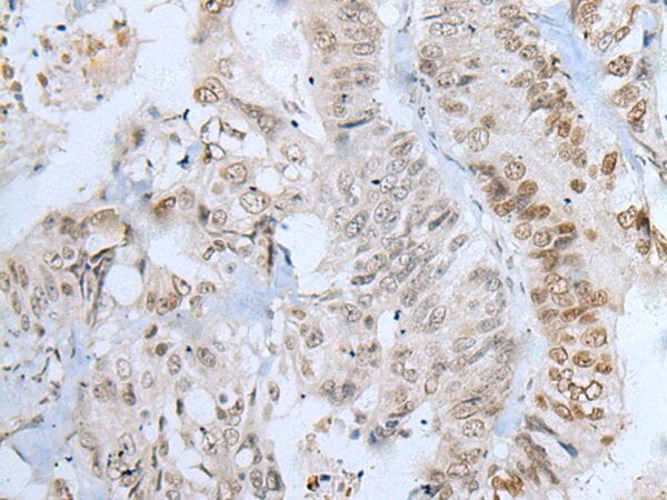 The image on the left is immunohistochemistry of paraffin-embedded Human colorectal cancer tissue using ZNF143 Antibody at dilution 1/20, on the right is treated with synthetic peptide. (Original magnification: x200)