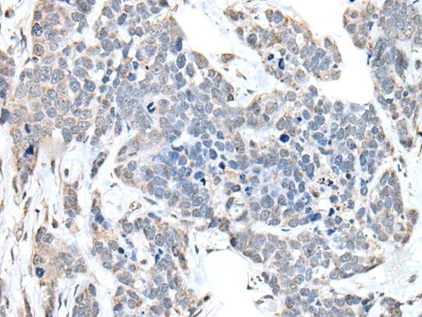 The image on the left is immunohistochemistry of paraffin-embedded Human thyroid cancer tissue using ANKRD27 Antibody at dilution 1/30, on the right is treated with fusion protein. (Original magnification: x200)