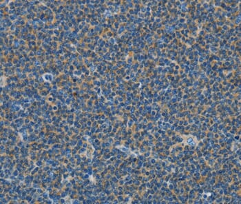 Immunohistochemical analysis of paraffin-embedded Human lymphoma tissue using #35583 at dilution 1/15.