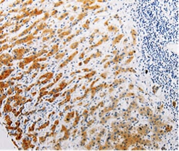 Immunohistochemical analysis of paraffin-embedded Human liver cancer tissue using #35685 at dilution 1/15.