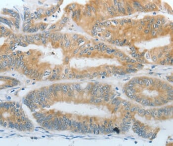 Immunohistochemical analysis of paraffin-embedded Human thyroid cancer tissue using #35857 at dilution 1/30.