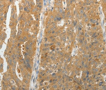 Immunohistochemical analysis of paraffin-embedded Human ovarian cancer tissue using #35950 at dilution 1/10.