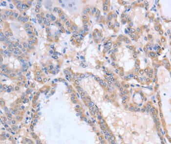 Immunohistochemical analysis of paraffin-embedded Human thyroid cancer tissue using #36028 at dilution 1/15.