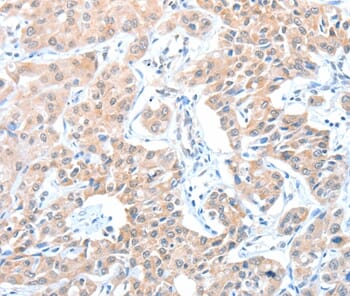 Immunohistochemical analysis of paraffin-embedded Human thyroid cancer tissue using #36044 at dilution 1/15.
