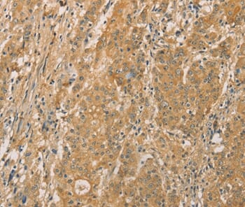 Immunohistochemical analysis of paraffin-embedded Human gastric cancer tissue using #36109 at dilution 1/20.