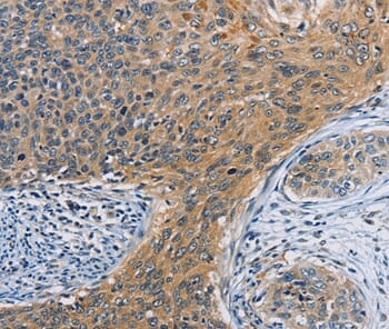 Immunohistochemical analysis of paraffin-embedded Human cervical cancer tissue using #36145 at dilution 1/20.