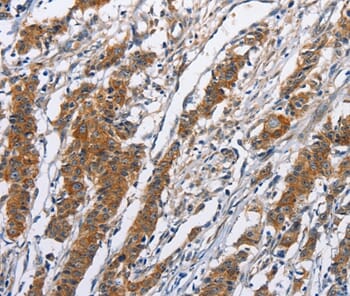 Immunohistochemical analysis of paraffin-embedded Human gastric cancer tissue using #36306 at dilution 1/50.