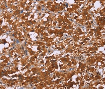 Immunohistochemical analysis of paraffin-embedded Human thyroid cancer tissue using #36401 at dilution 1/50.