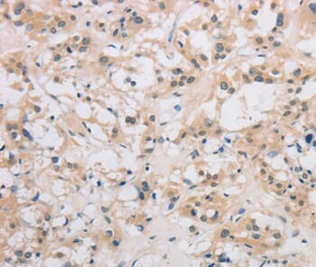 Immunohistochemical analysis of paraffin-embedded Human thyroid cancer tissue using #36408 at dilution 1/40.