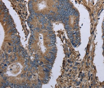 Immunohistochemical analysis of paraffin-embedded Human colon cancer tissue using #36495 at dilution 1/30.