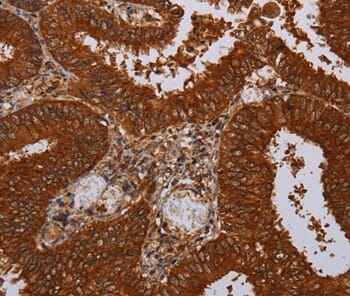 Immunohistochemical analysis of paraffin-embedded Human colon cancer tissue using #36612 at dilution 1/50.