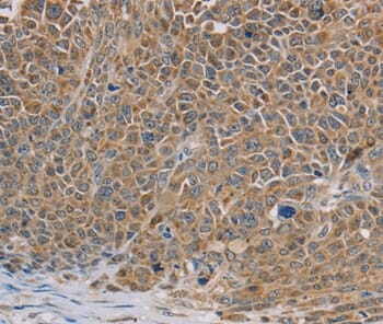 Immunohistochemical analysis of paraffin-embedded Human ovarian cancer tissue using #36642 at dilution 1/40.