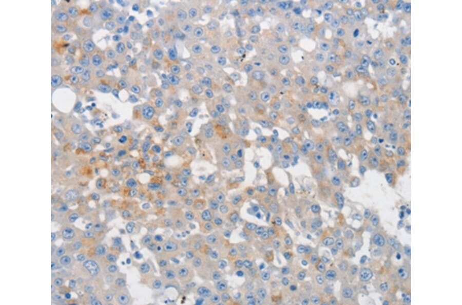 Immunohistochemistry - MUC5AC Antibody from Signalway Antibody (36988) - Antibodies.com
