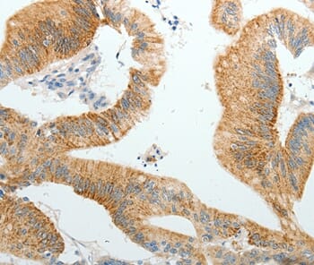 Immunohistochemical analysis of paraffin-embedded Human colon cancer tissue using #37066 at dilution 1/10.