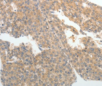Immunohistochemical analysis of paraffin-embedded Human ovarian cancer tissue using #37070 at dilution 1/25.