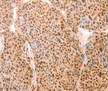 Immunohistochemical analysis of paraffin-embedded Human lymphoma tissue using #37097 at dilution 1/15.