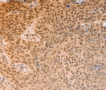 Immunohistochemical analysis of paraffin-embedded Human liver cancer tissue using #37097 at dilution 1/15.