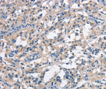 Immunohistochemical analysis of paraffin-embedded Human thyroid cancer tissue using #37109 at dilution 1/30.