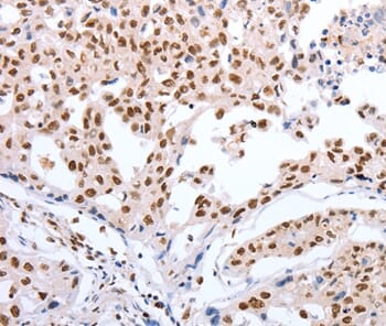 Immunohistochemical analysis of paraffin-embedded Human ovarian cancer tissue using #37201 at dilution 1/40.