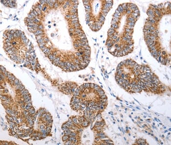 Immunohistochemical analysis of paraffin-embedded Human colon cancer tissue using #37203 at dilution 1/70.