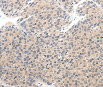 Immunohistochemical analysis of paraffin-embedded Human breast cancer tissue using #37234 at dilution 1/25.