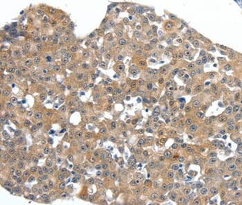 Immunohistochemical analysis of paraffin-embedded Human oesophagus cancer tissue using #37235 at dilution 1/40.