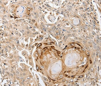 Immunohistochemical analysis of paraffin-embedded Human oesophagus cancer tissue using #37242 at dilution 1/35.