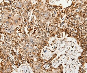 Immunohistochemical analysis of paraffin-embedded Human oesophagus cancer tissue using #37247 at dilution 1/60.