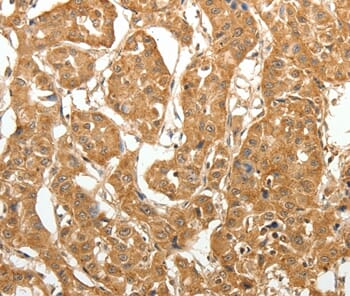 Immunohistochemical analysis of paraffin-embedded Human lung cancer tissue using #37266 at dilution 1/60.