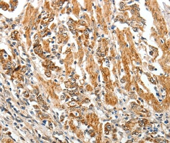 Immunohistochemical analysis of paraffin-embedded Human lung cancer tissue using #37272 at dilution 1/60.