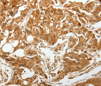 Immunohistochemical analysis of paraffin-embedded Human gastric cancer tissue using #37272 at dilution 1/60.