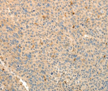 Immunohistochemical analysis of paraffin-embedded Human thyroid cancer tissue using #37278 at dilution 1/30.