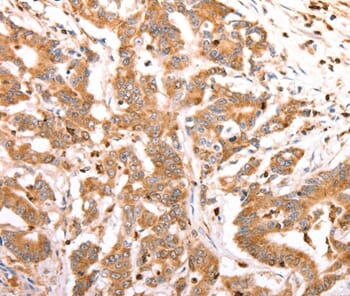 Immunohistochemical analysis of paraffin-embedded Human colon cancer tissue using #37302 at dilution 1/20.