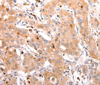 Immunohistochemical analysis of paraffin-embedded Human lung cancer tissue using #37302 at dilution 1/20.