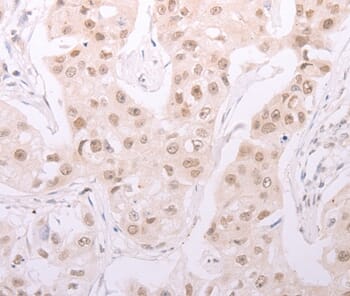 Immunohistochemical analysis of paraffin-embedded Human breast cancer tissue using #37309 at dilution 1/30.