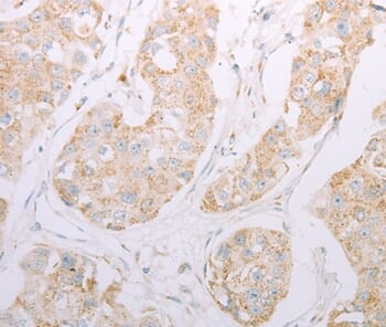 Immunohistochemical analysis of paraffin-embedded Human breast cancer tissue using #37311 at dilution 1/30.