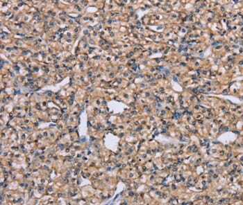 Immunohistochemical analysis of paraffin-embedded Human prostate cancer tissue using #37312 at dilution 1/40.
