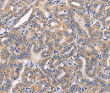 Immunohistochemical analysis of paraffin-embedded Human thyroid cancer tissue using #37461 at dilution 1/50.