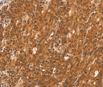 Immunohistochemical analysis of paraffin-embedded Human gastric cancer tissue using #37520 at dilution 1/40.
