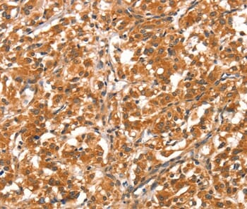 Immunohistochemical analysis of paraffin-embedded Human thyroid cancer tissue using #37520 at dilution 1/40.