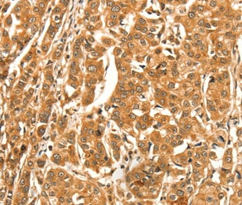 Immunohistochemical analysis of paraffin-embedded Human breast cancer tissue using #37536 at dilution 1/30.