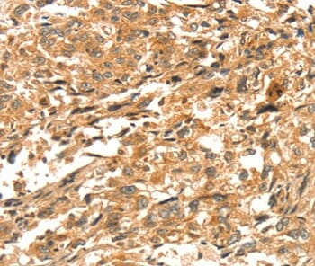 Immunohistochemical analysis of paraffin-embedded Human oesophagus cancer tissue using #37536 at dilution 1/30.