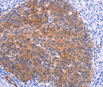 Immunohistochemical analysis of paraffin-embedded Human cervical cancer tissue using #37565 at dilution 1/30.