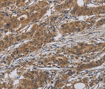 Immunohistochemical analysis of paraffin-embedded Human gastric cancer tissue using #37660 at dilution 1/40.