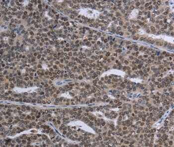Immunohistochemical analysis of paraffin-embedded Human ovarian cancer tissue using #37709 at dilution 1/30.