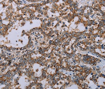 Immunohistochemical analysis of paraffin-embedded Human liver cancer tissue using #37735 at dilution 1/20.